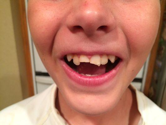 My son broke off both front teeth.