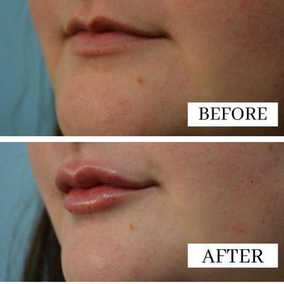 Amber used one syringe of Restylane Defyne, giving this patient a natural pout.