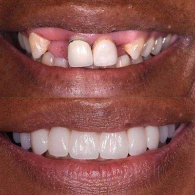 Before and After photo of New Image Dental patient in Los Angeles