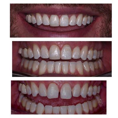 The top two photos are after the completion of Adult Invisalign and Cosmetic Composite Services, the bottom is the before photo.