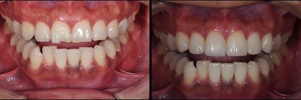 Smile lift with Composite Layered Bondings!