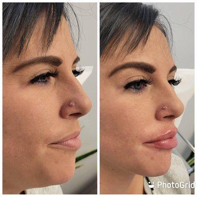 Lip Filler