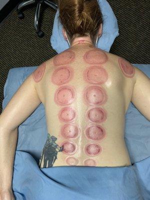 Cupping