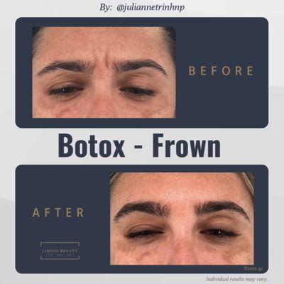 Botox Frown by Julianne Trinh NP