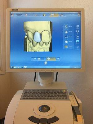 Cerec single visit crowns scanned and designed chairside