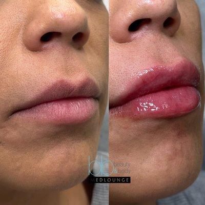 Lip filler