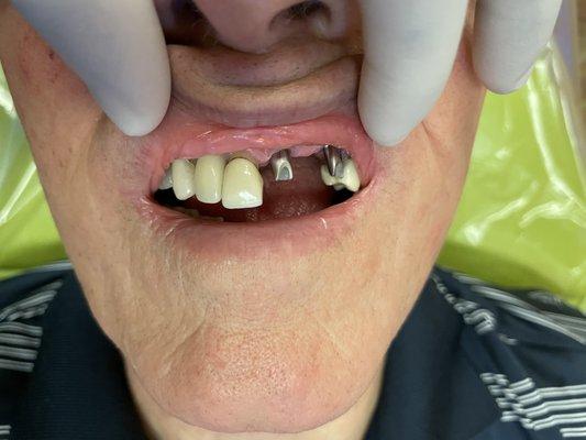 More than missing tooth can be restored by placing 2 implants and having a bridge on the top of them