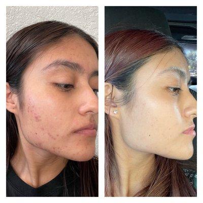 Janmarini resurfacing treatment