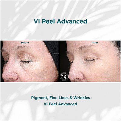 Pigment, Fine Lines and Wrinkles