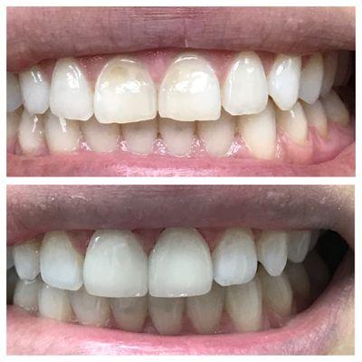 Ceramic veneers to restore acid worn two front teeth