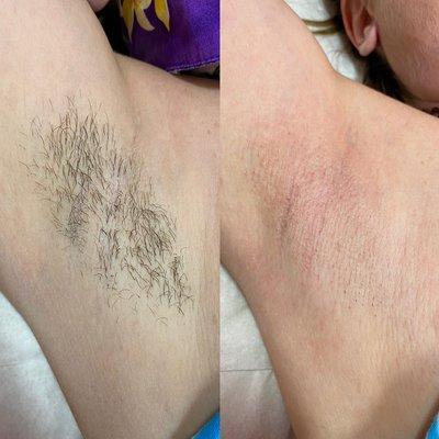 Underarm Wax - Before and After