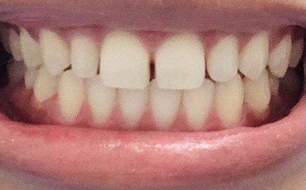 Before: I have gaps but straight teeth.