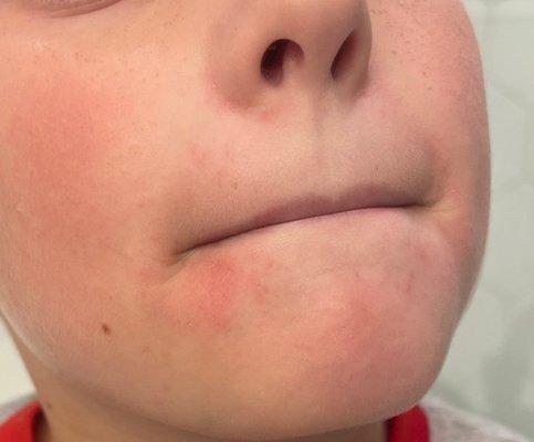 My sons face before we used the topical prescribed by Dr. Gavino