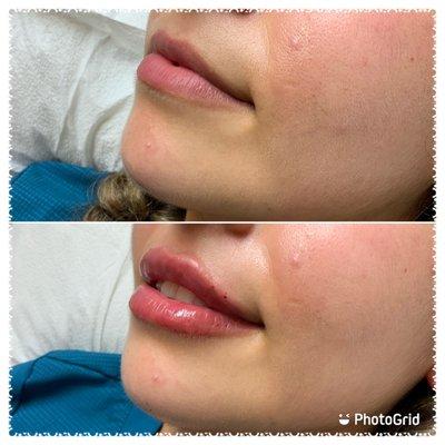 Lip filler