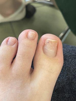 Cut down the left side of my toenail. You can see it is cracked too.