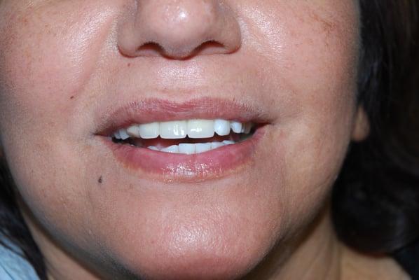 Front teeth Dental Implants