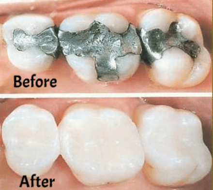 Beautiful White Fillings and Crowns