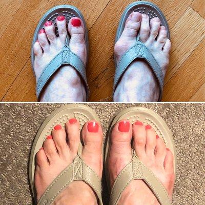 Happy fellow physician/patient sent me her before and after bunion surgery photos.  Damn I'm good ;)