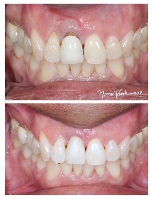 An unsightly anterior crown is replaced with a natural, matching crown, and whitening with repair of the broken tooth