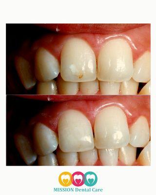 Our patient came in with slight discoloration and staining; we enhanced their smile with dental bonding :)