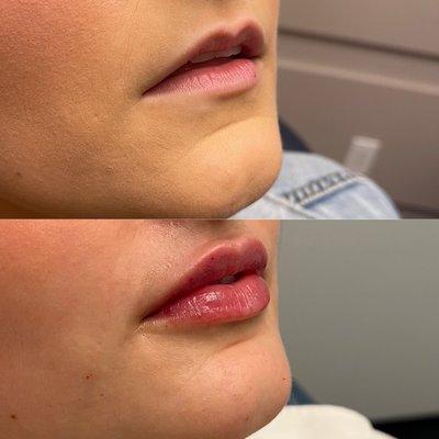 Lip Filler