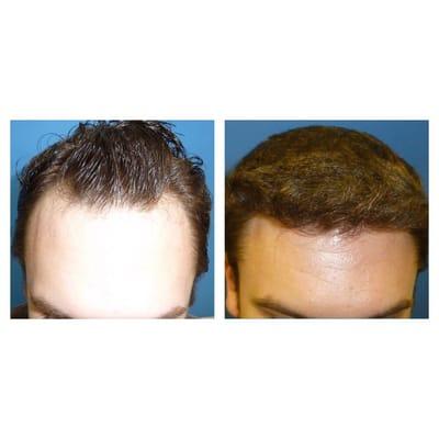 26year old before and after FUE Hairtransplant 2500 G one session