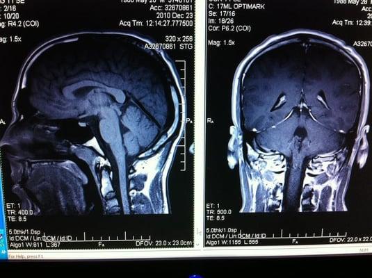 Concussion Injury Seen in MRI of NHL Hockey Player.