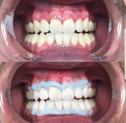 Before and After results from our in office whitening treatment