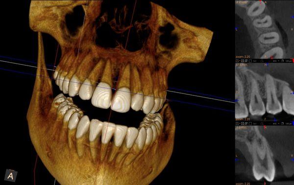 Cone beam computed tomography allows visualization in 3 dimensions.