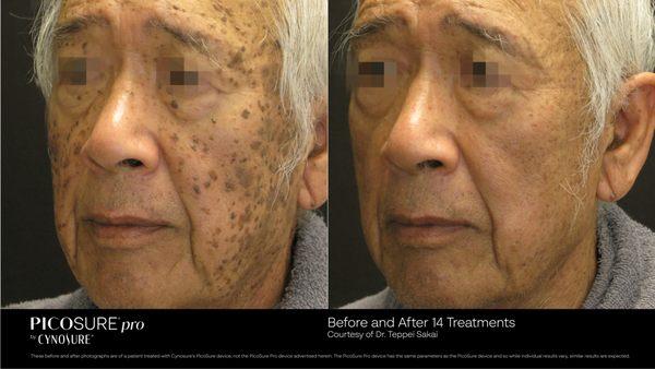 before and after treatment of pigmented lesion