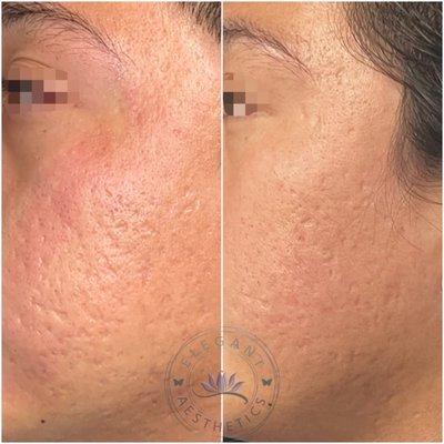 Microneedling