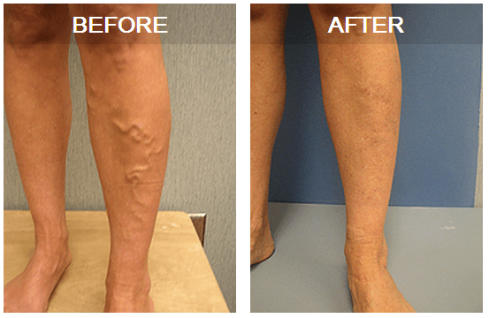 Varicose veins & spider veins treated at Vein Specialists of the South