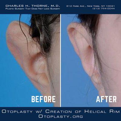 Otoplasty.org: Otoplasty with Creation  of Helical Rim Before & After Images