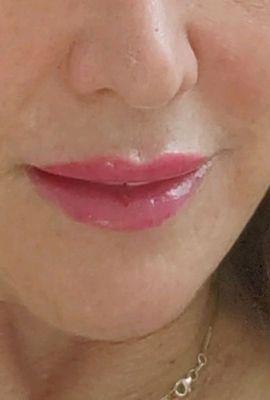 The beauty of this procedure is I only after to wear clear lip gloss.No more lipstick on my teeth Thank you .  Judy D