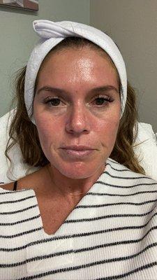 After HYDRAFACIAL glow