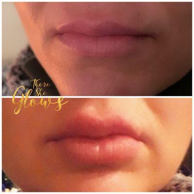 Hyaluron Pen (needles lip fillers)