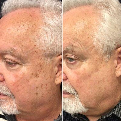 Before and after ICON IPL treatment