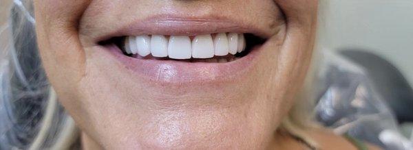 Smile makeover done with minimal preparation of teeth. Teeth restored with emax , highly esthetic crowns and venners.