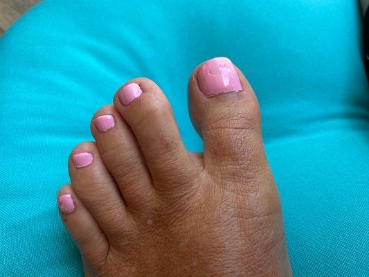 Botched pedicure