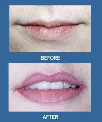 Lips can be made to look fuller, more youthful, and naturally colorful with permanent makeup by Jeffery Lyle Segal.