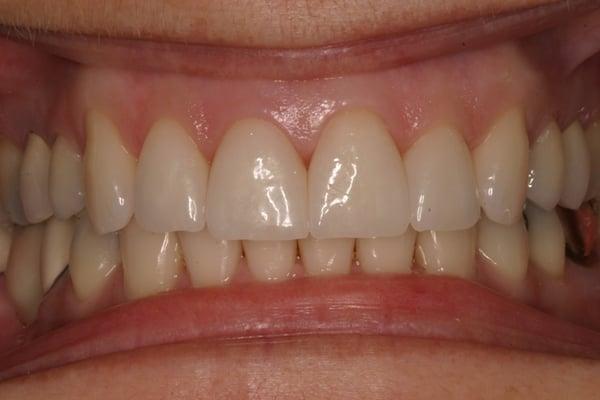 Crowns on 4 front teeth