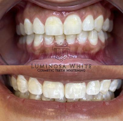 Removed two deep yellowish stains on the front teeth and lighten up the rest of the teeth, results in only 60 minutes!