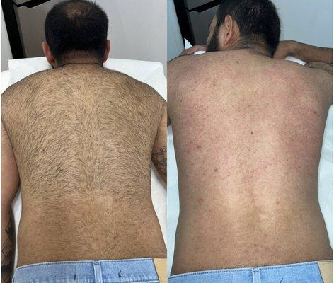 Mens back before and after