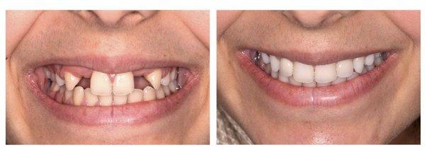 Click on image to see full before and after of dental implants for missing lateral incisors