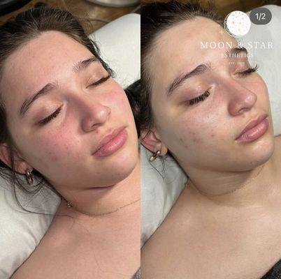 Before & After: Oxygen Facial