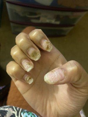 Mold / bruising in my nails