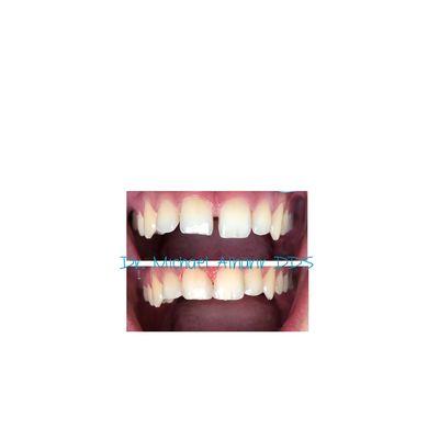 Diastema closure with Composite restorations. Nice results in one visit.