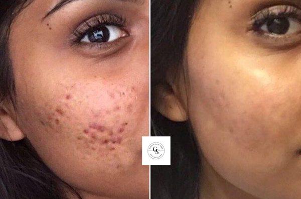 Acne Facial Results