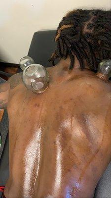 Glass cupping on shoulder and back muscles