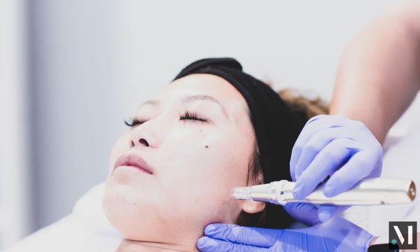 Liquid and Cellular Facelifts with PRP